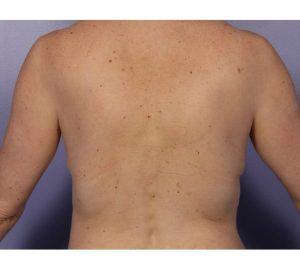CoolSculpting back fat after