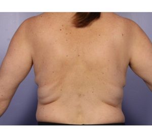 CoolSculpting back fat before