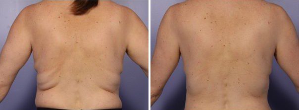 coolsculpting fat freezing back fat before and after
