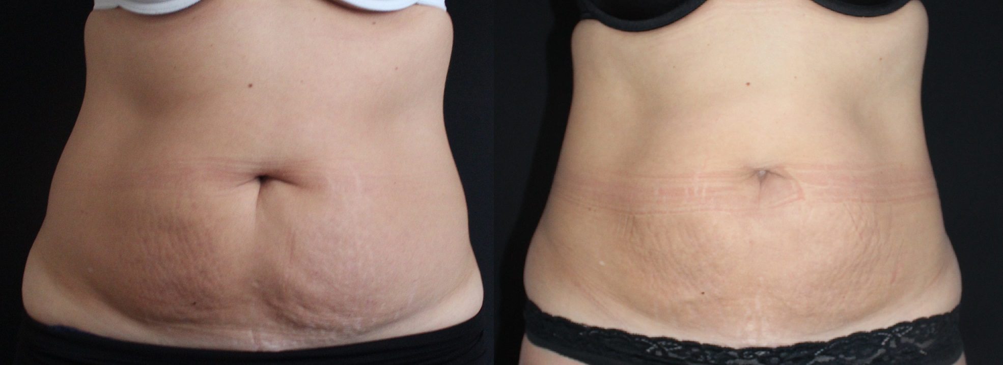 CoolSculpting before and after abdomen and waist