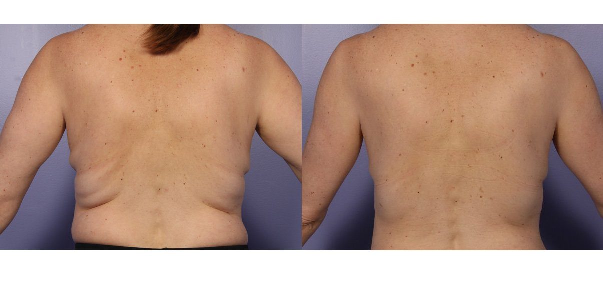 CoolSculpting before and after back fat