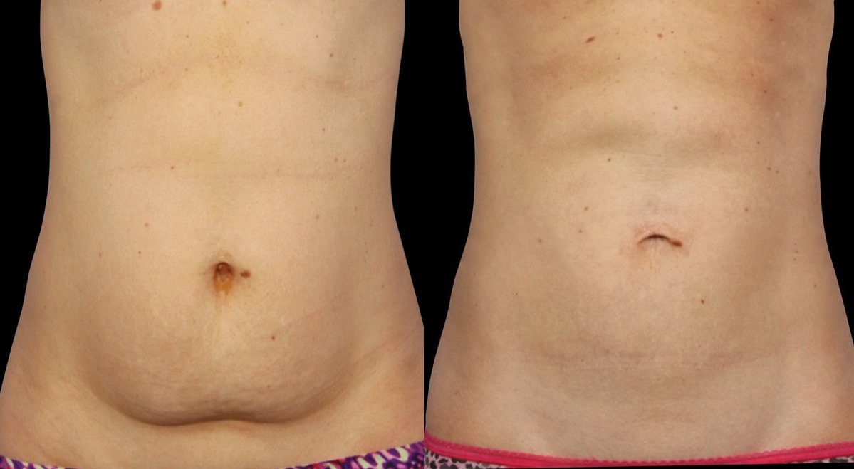 CoolSculpting before and after mummy tummy belly fat