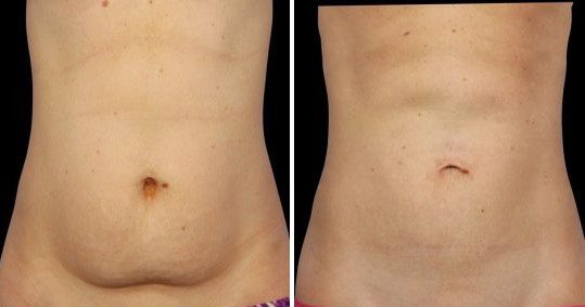 CoolSculpting belly fat removal before and after