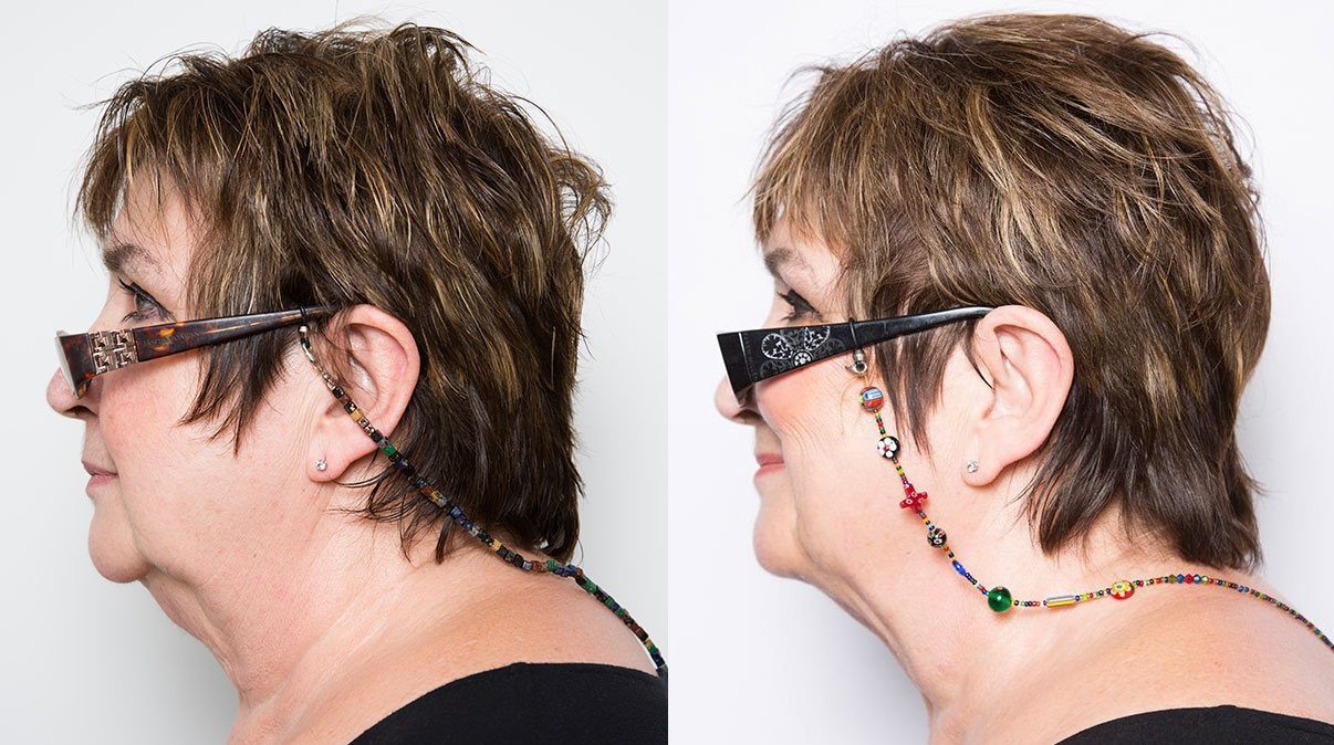 CoolSculpting double chin before and after - Jenni Murray