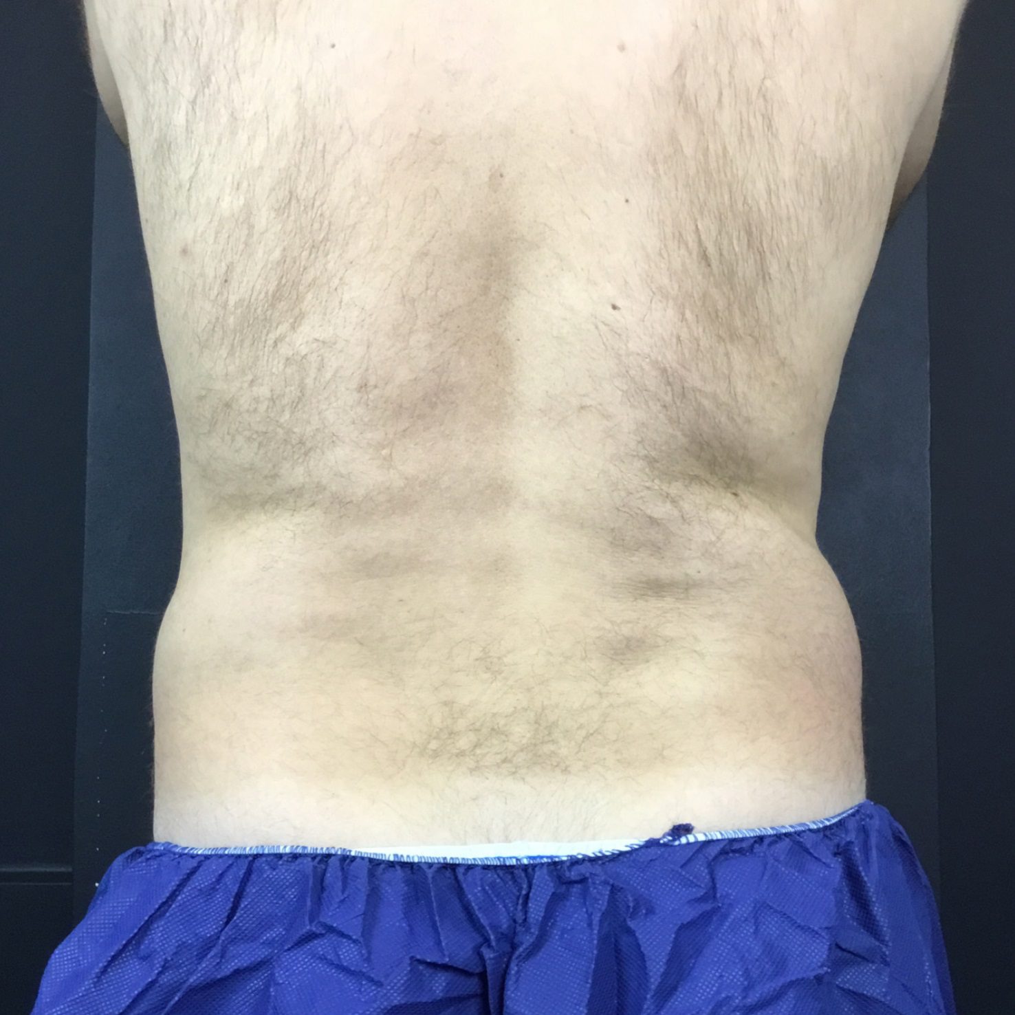 coolsculpting fat freezing muffin top, flanks before
