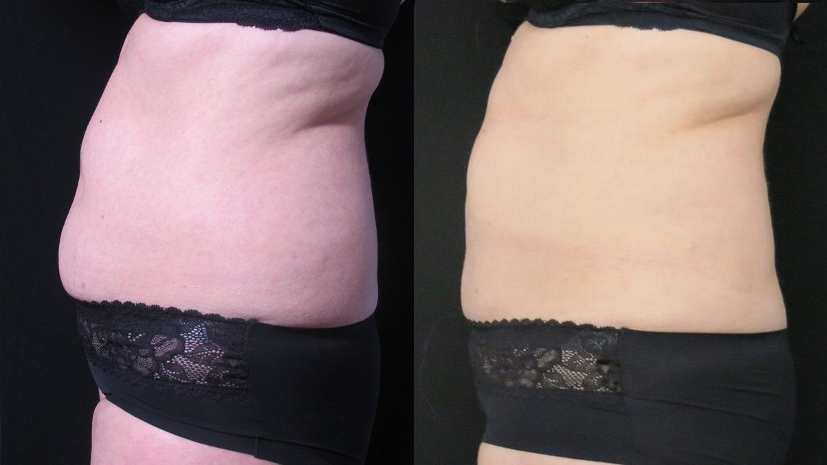 CoolSculpting fat freezing abdomen fat before and after