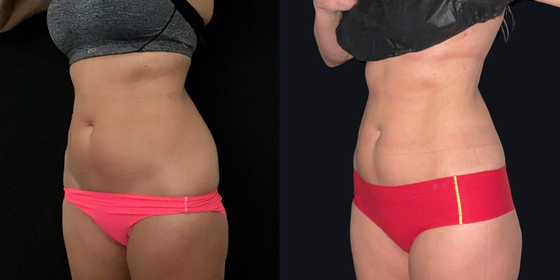 coolsculpting fat freezing belly fat before and after Ria Murch