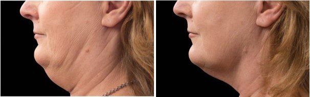 coolsculpting double chin before and after