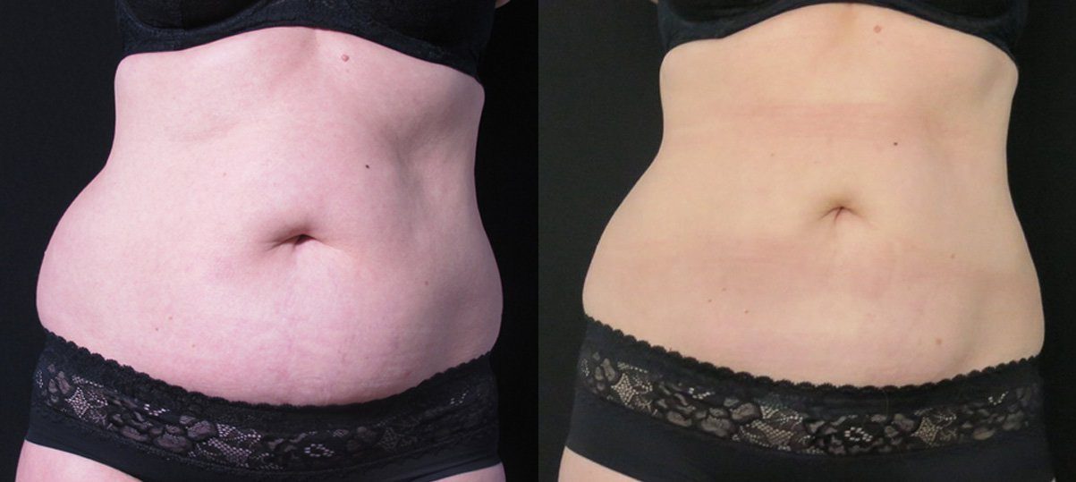 CoolSculpting fat freezing stomach fat before and after