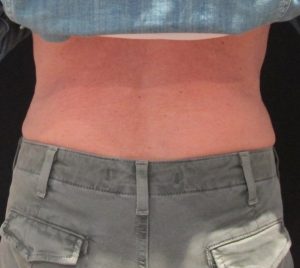 CoolSculpting men after - muffin top