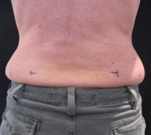 CoolSculpting men before - muffin top