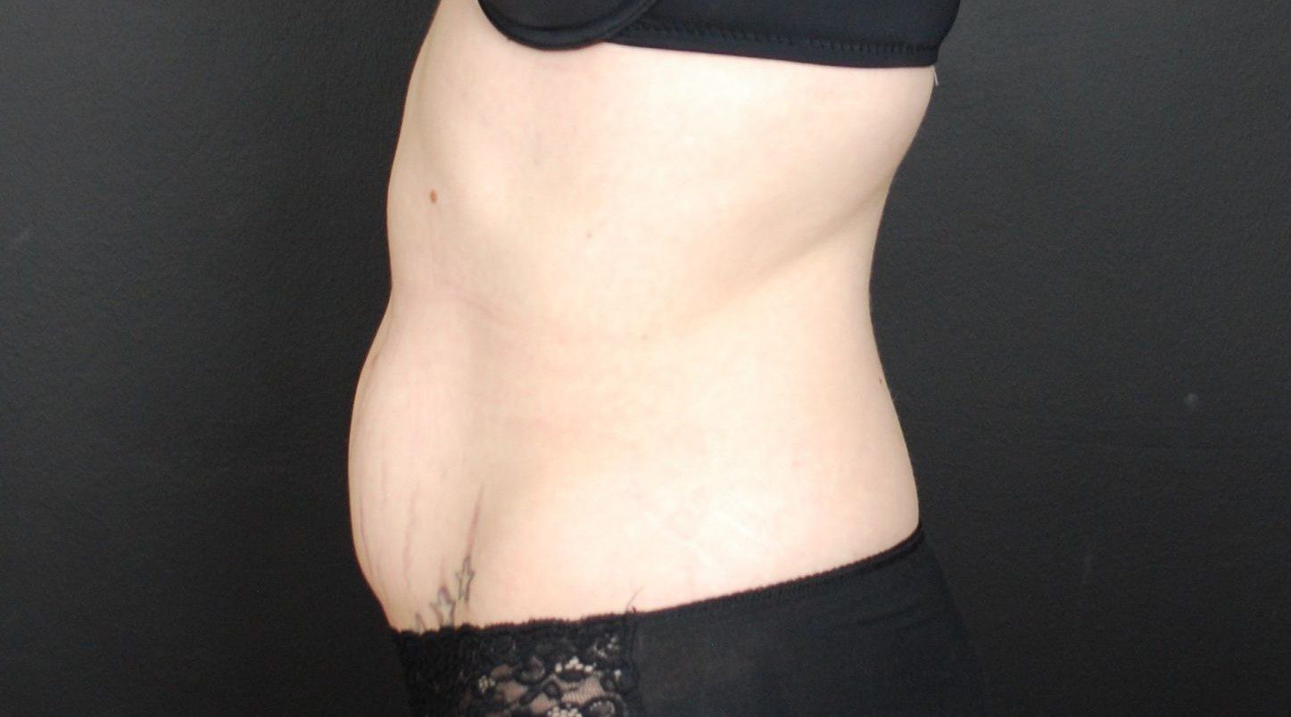 CoolSculpting mummy tummy After