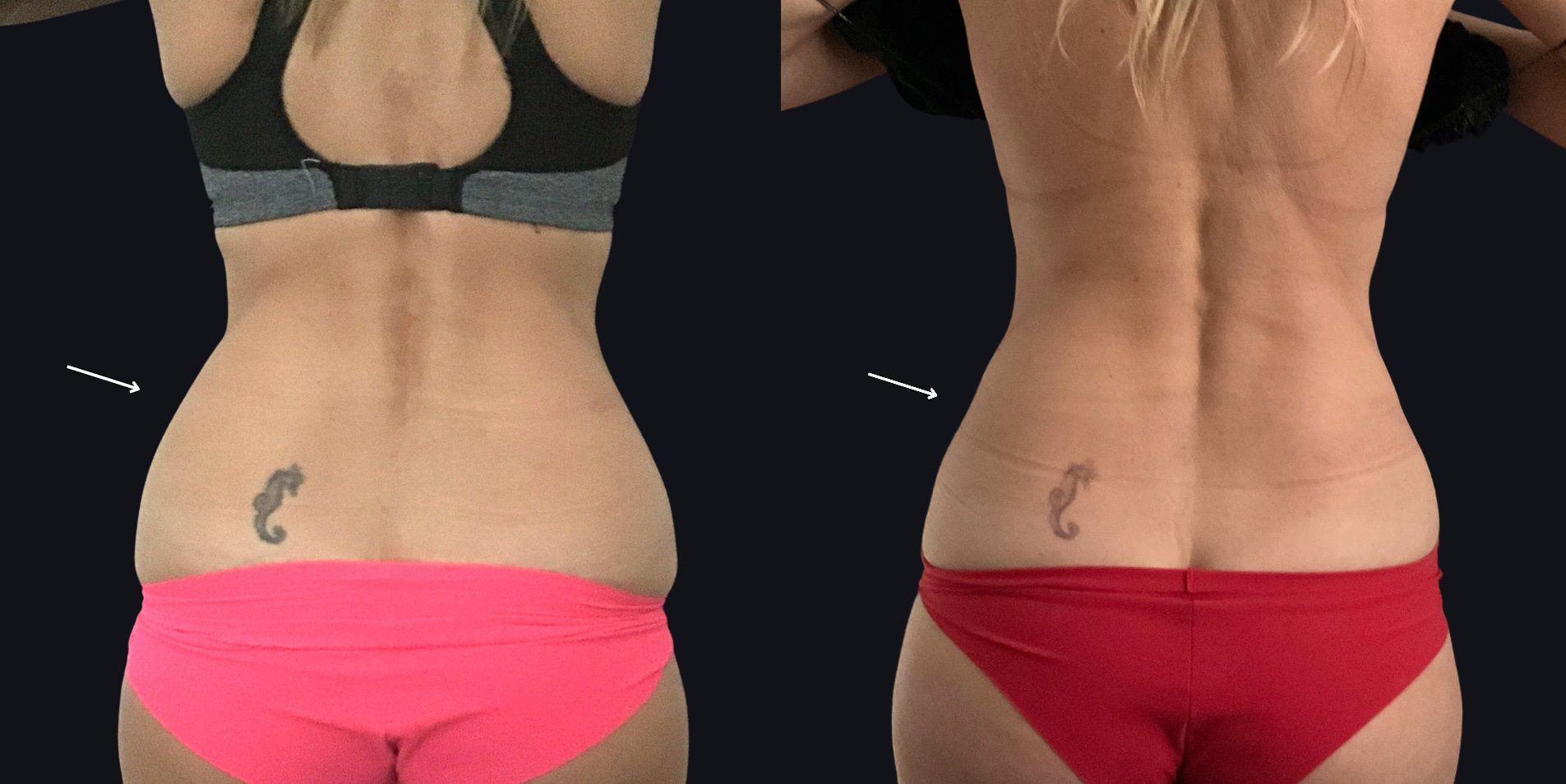 coolsculpting on back fat before and after Ria Murch