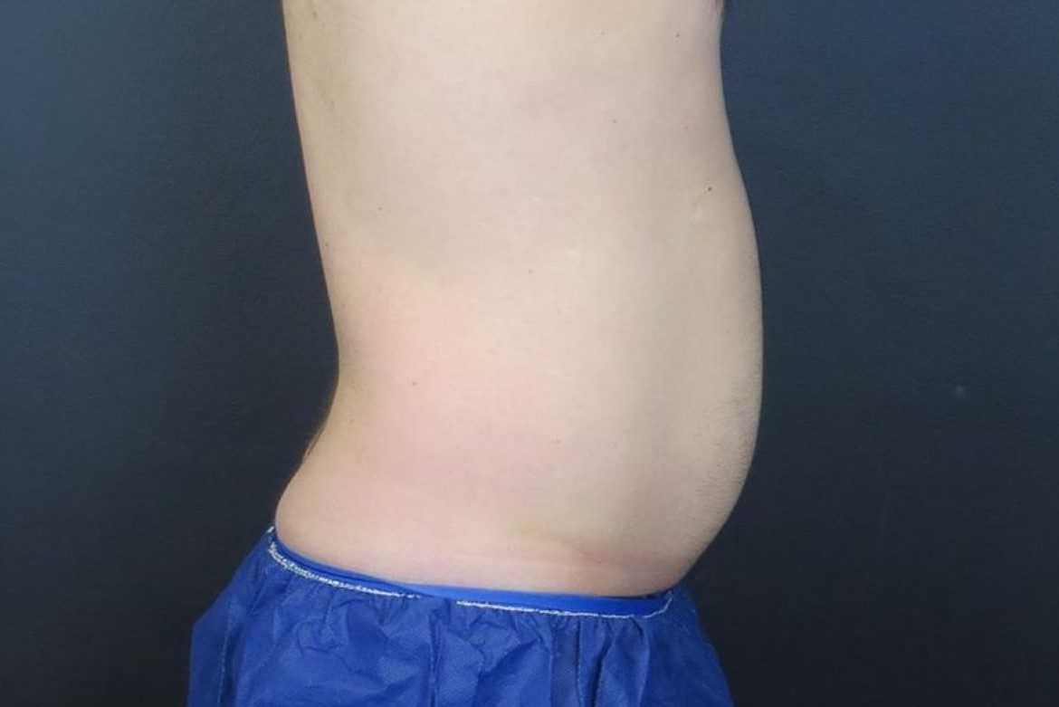 coolsculpting stomach fat before