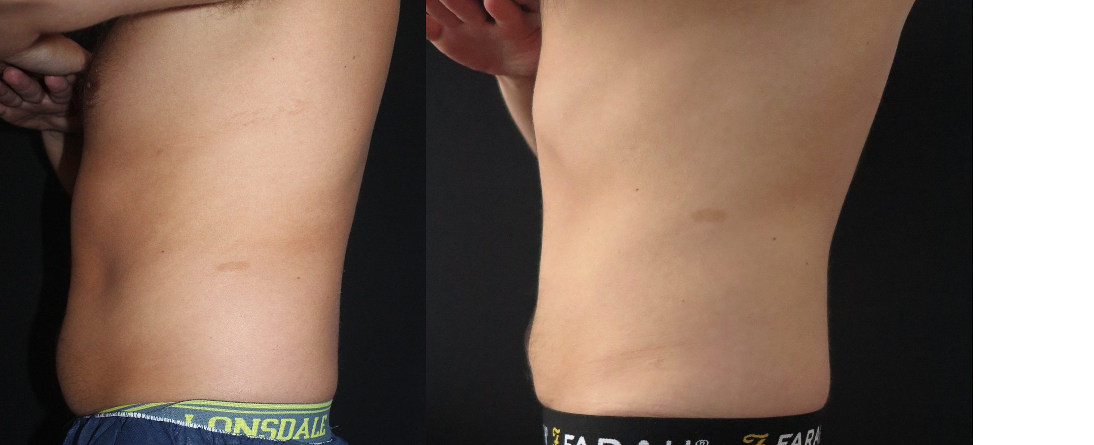 CoolSculpting stubborn belly fat before and after