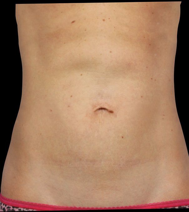 A flat stomach following CoolSculpting to the abdomen