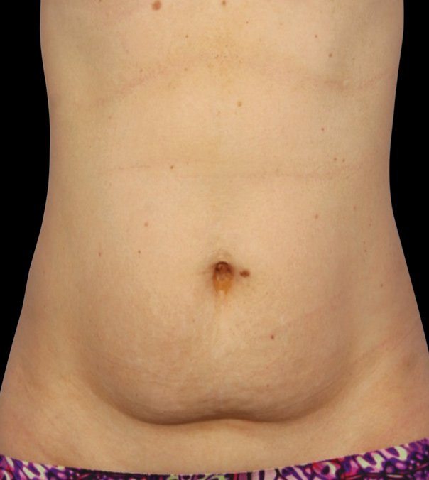 A flabby stomach before CoolSculpting treatment to the abdomen