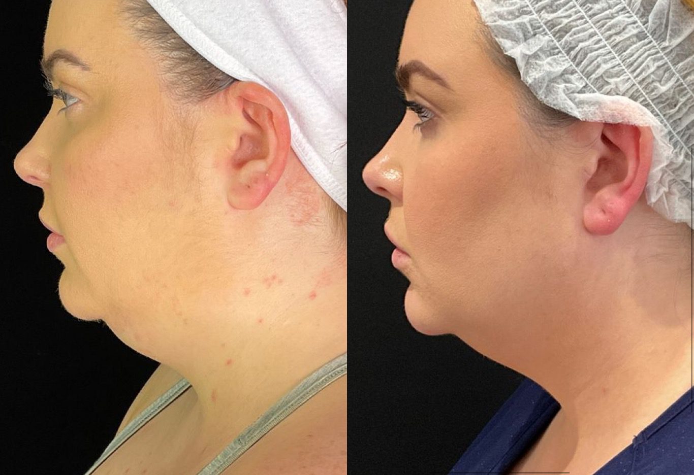 Coolmini - Double chin coolsculpting fat freezing before and after - By Magda Szczukiewicz