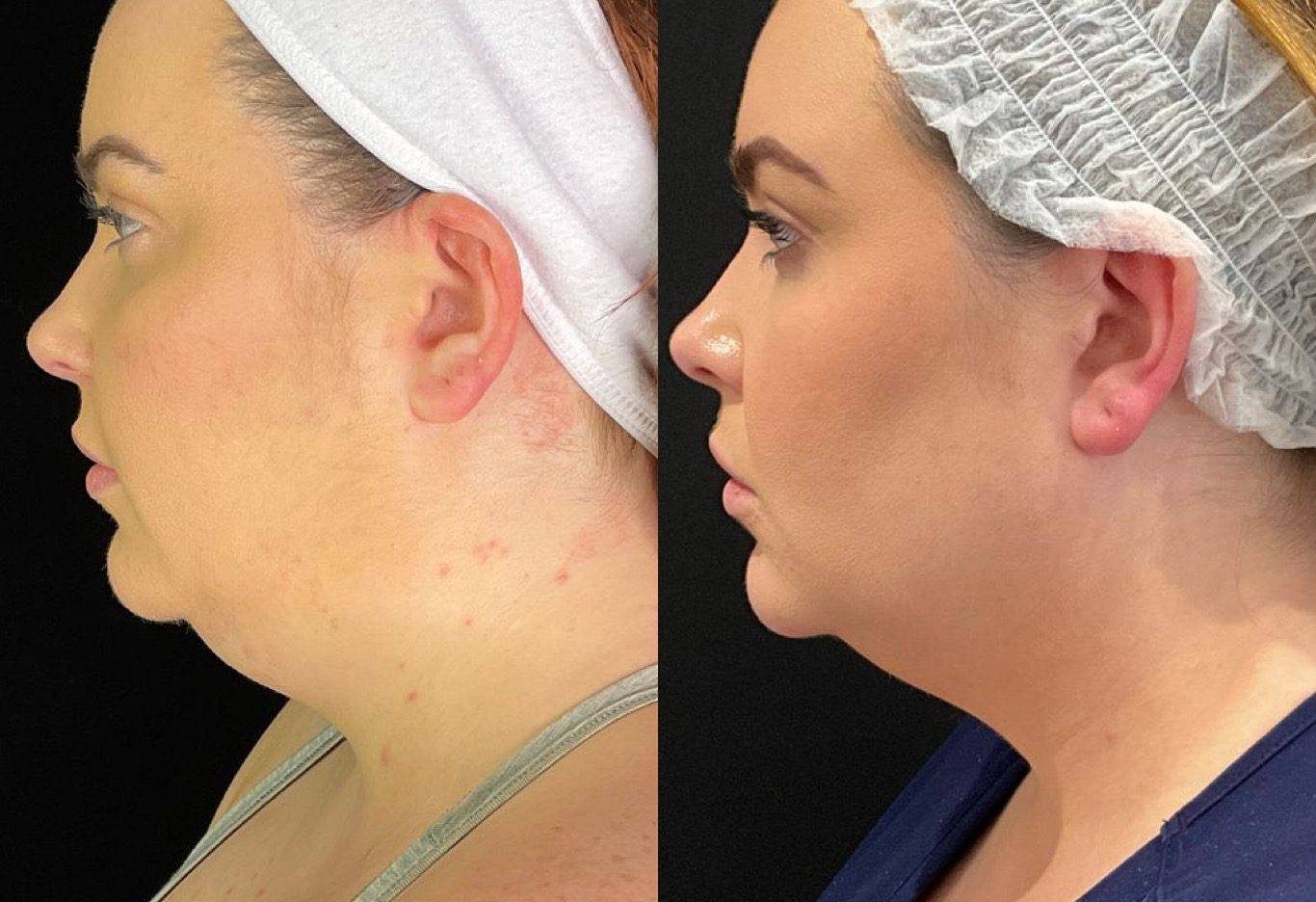Coolmini - Double chin fat freezing before and after - By Magda Szczukiewicz