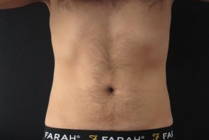 Coolsculpting Fat Freezing Abdomen After
