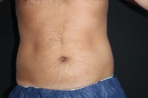 Coolsculpting Fat Freezing Abdomen Before