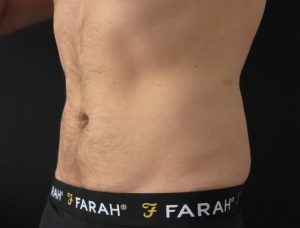 Coolsculpting Fat Freezing side Abdomen After