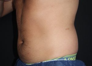Coolsculpting Fat Freezing side Abdomen Before