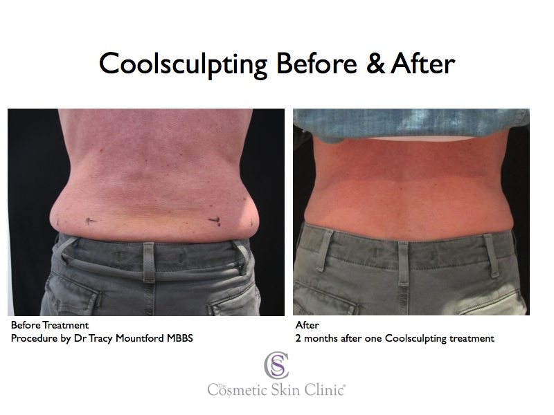 Coolsculpting.Muffin.top