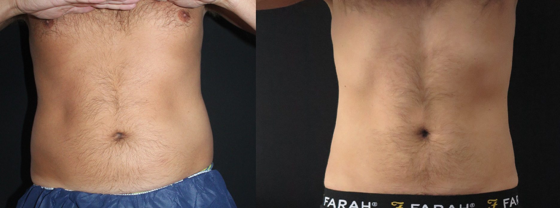 coolsculpting abdomen fat before and after