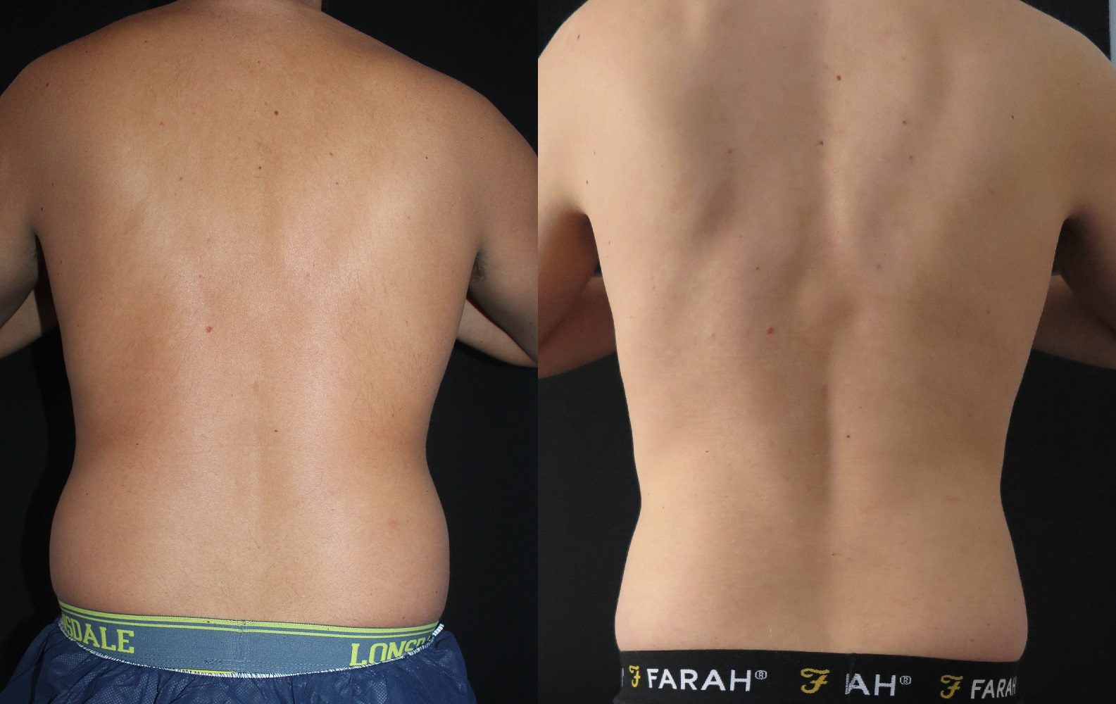 coolsculpting before and after back fat