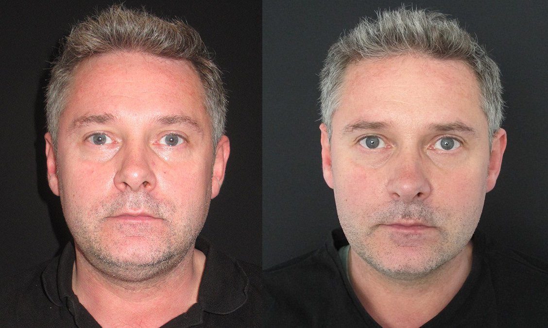 Coolsculpting mini before and after double chin - Jason-Gardiner