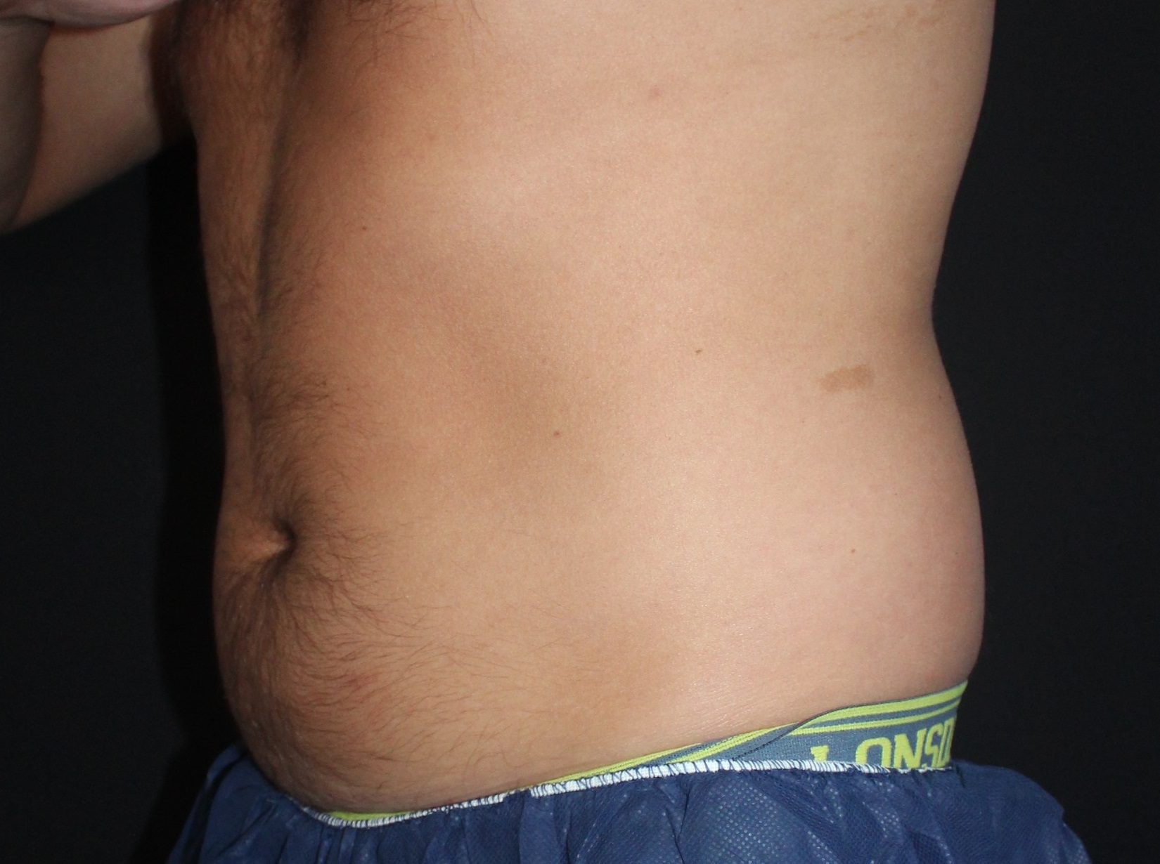 Coolsculpting side Abdomen Before