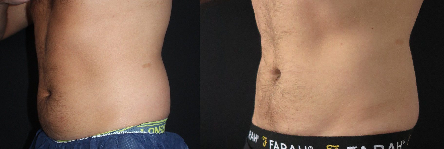 Coolsculpting side Abdomen before and after