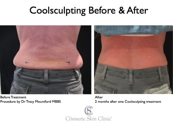 CoolSculpting London - Fat freezing treatments