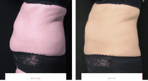 Before and after picture of female CoolSculpting patient