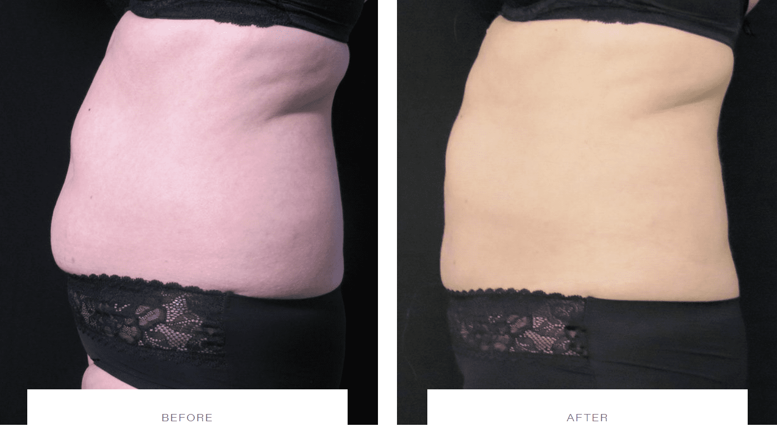 CoolSculpting does it work on Belly Fat CoolSculpting Belly Fat