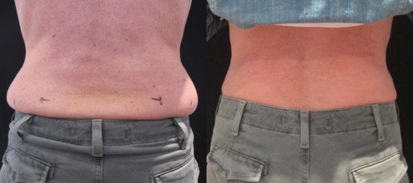 cryolipolysis london, fat freezing muffin tops before and after