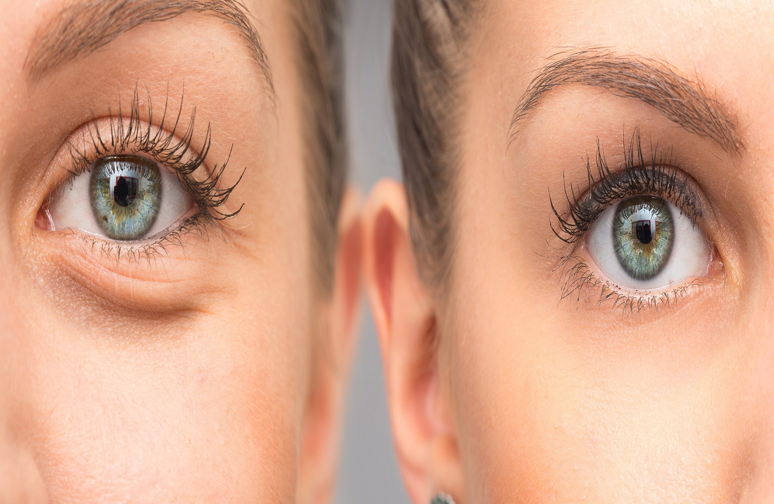 How To Get Rid Of Sunken Eyes And Dark Circles