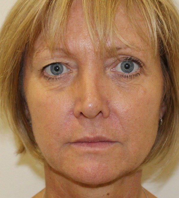 A lady following collagen stimulating treatment and thread lifting to jaw line and mid face