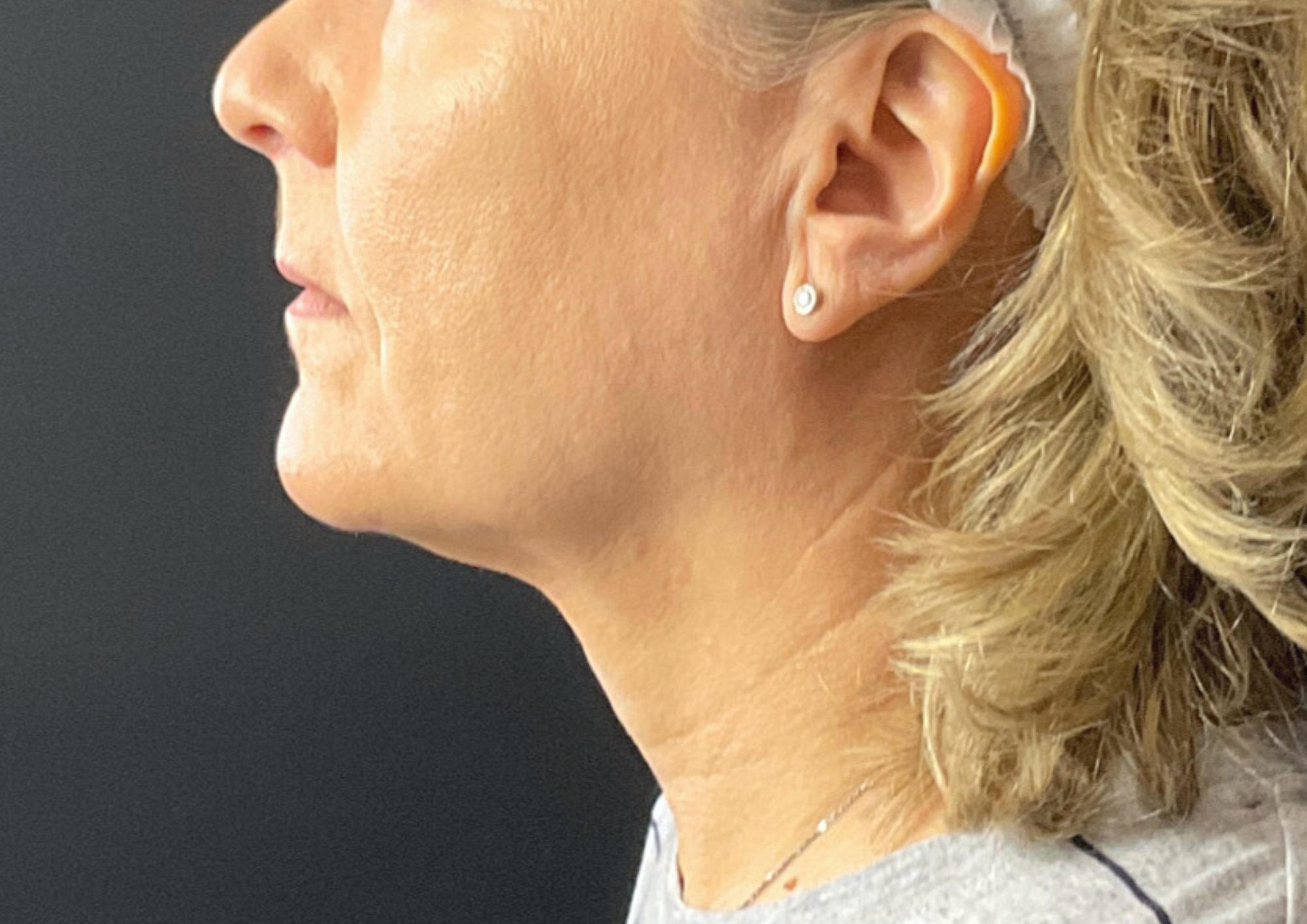 Dermal Filler Morpheus8 lower face Before