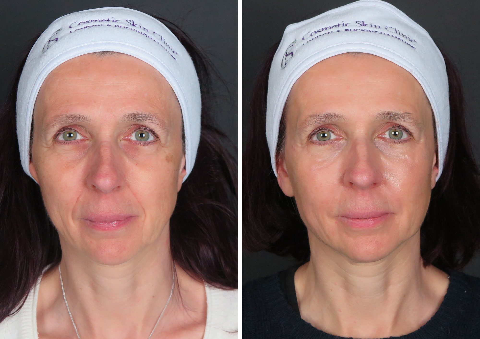 Dermal Fillers nasolabial folds before and after