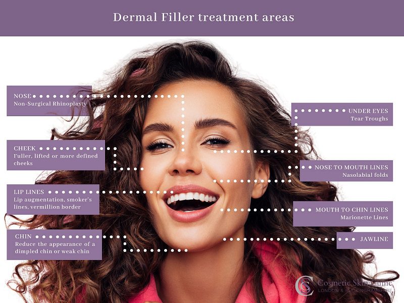 Dermal Filler treatment areas infographic - Dermal Fillers London-Buckinghamshire