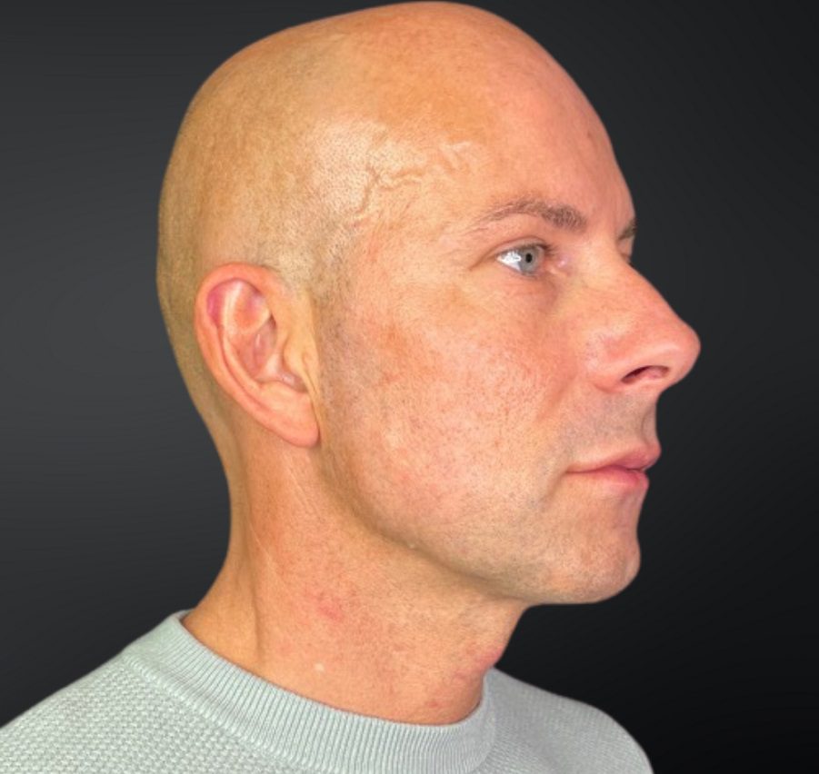 Dermal Fillers After Lower Face by Lee Garrett Side