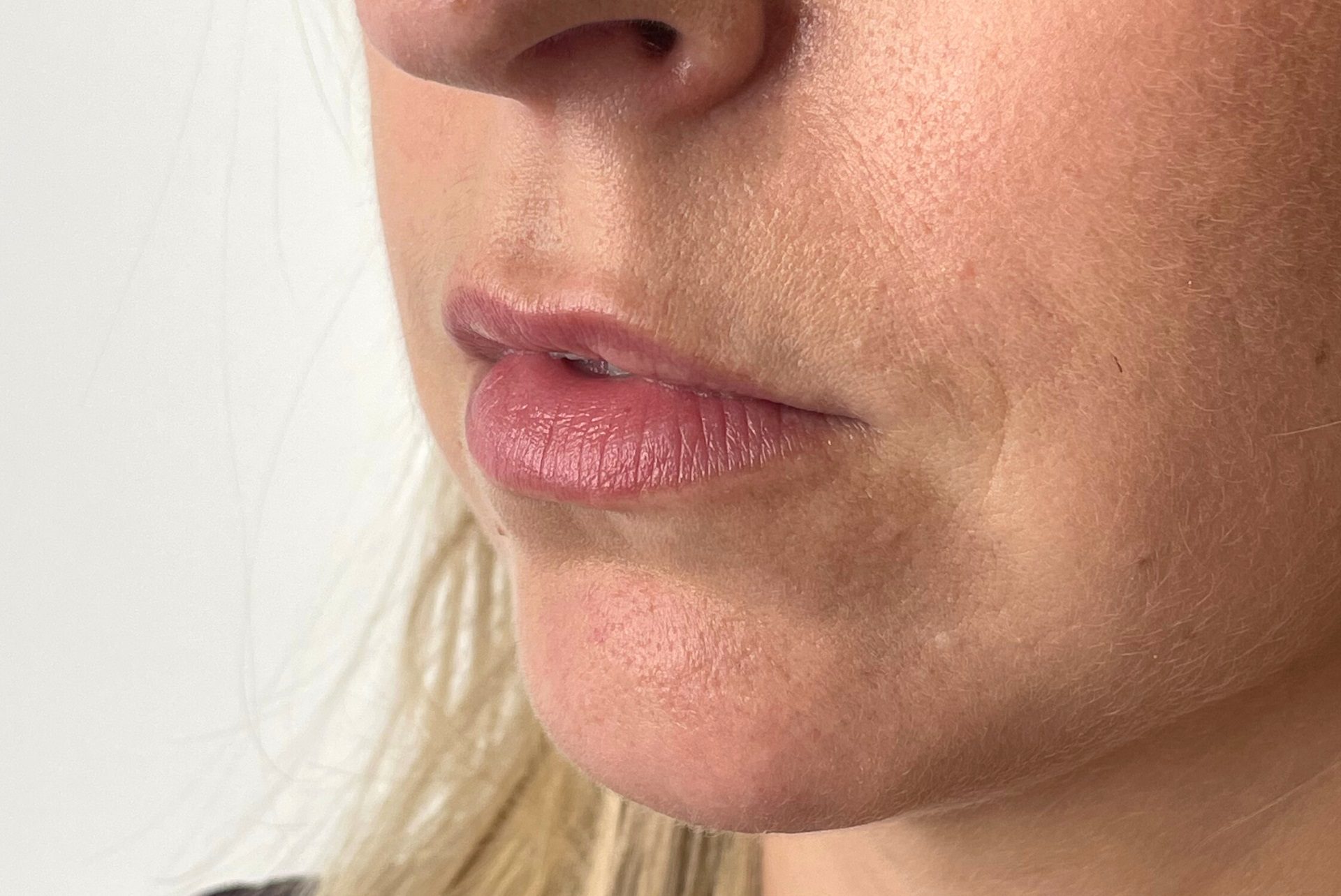 barcode lip lines, upper lip lines dermal fillers after