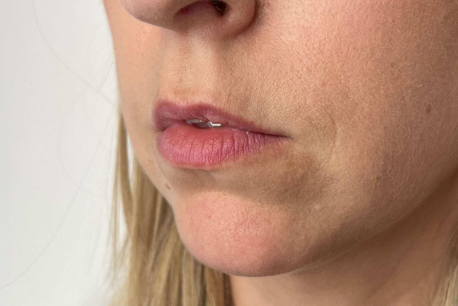 barcode lip lines, upper lip lines dermal fillers before