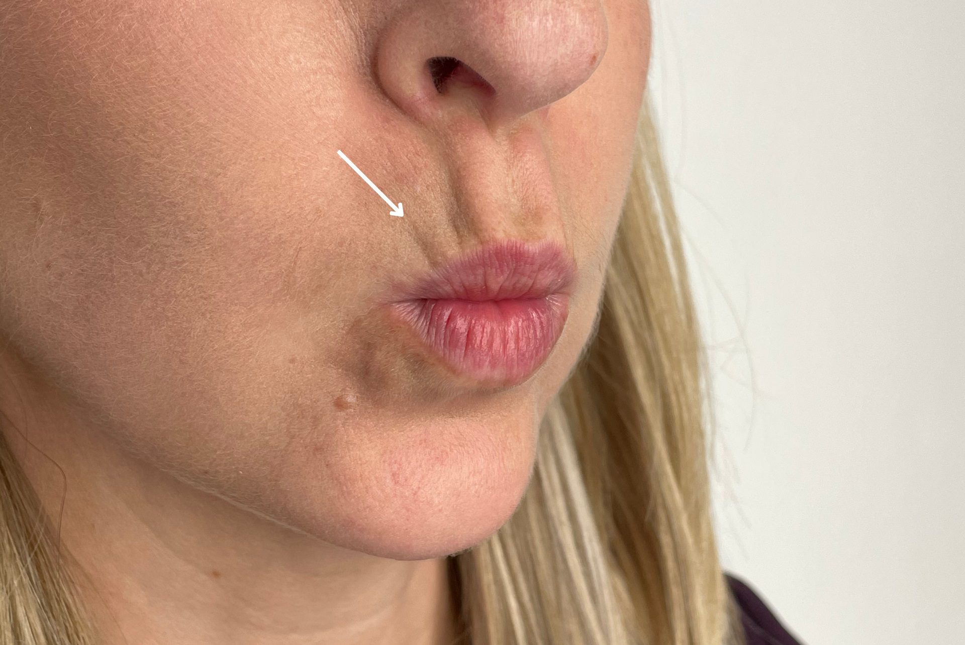 dermal fillers barcode lip lines before