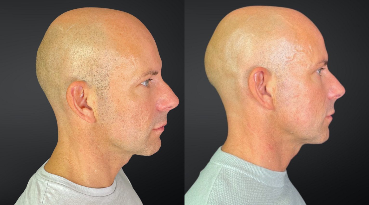 dermal fillers lower face lift on male patient before and after