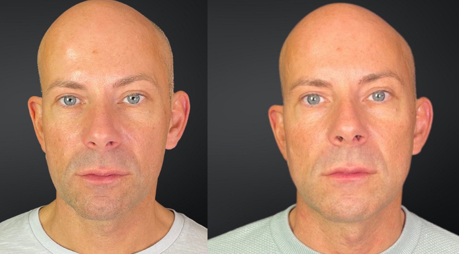 dermal fillers jawline contour lower facelift before and after