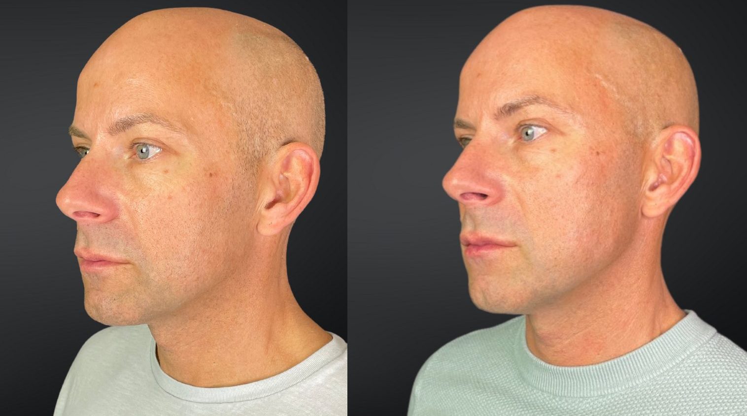 fillers men jaw line and lower face before and after