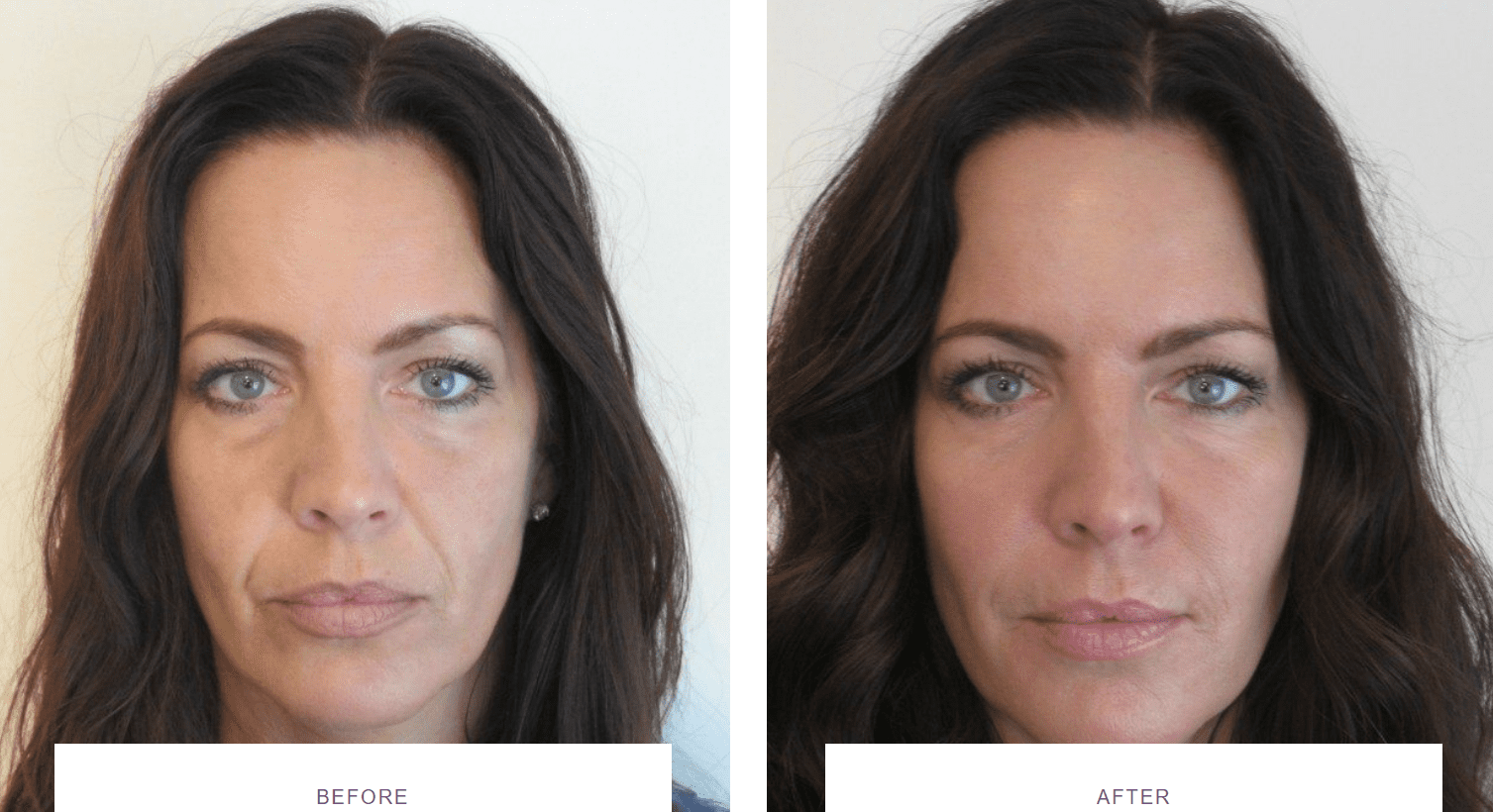 nose to mouth lines tear troughs dermal fillers before after